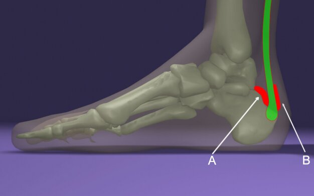 achilles-bursitis