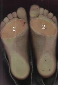 talp harántsüllyedés