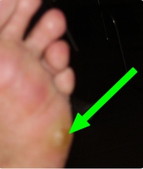 digitus-quintus-varus2