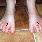 Fájdalom a lábujjak alatt, harántsüllyedés