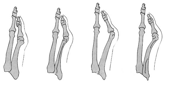 metatarsus-quintus-varus