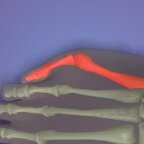 Digitus quintus varus