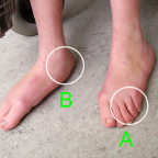 Teljesen ellapult láb és az előláb kifelé fordul