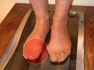 hallux rigidus