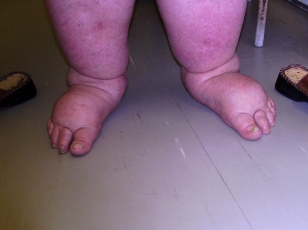 Elefantiasis, Lymphangiectasia