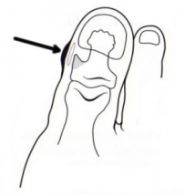 phalanx-distalis-hallucis